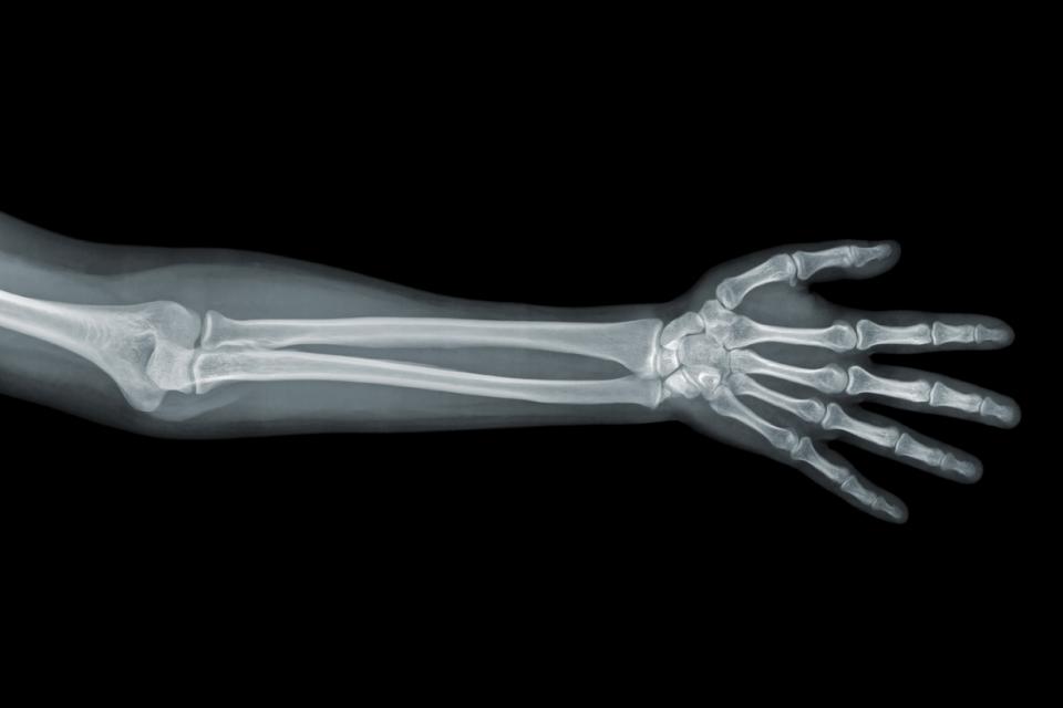 X-ray of arm